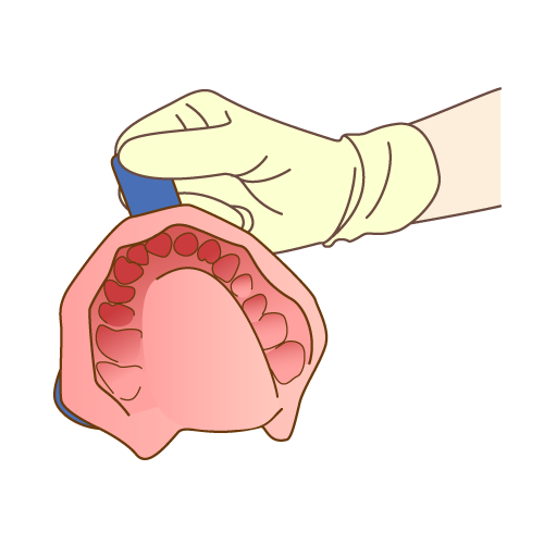 印象採取、仮歯の装着