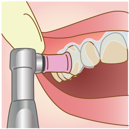 歯のクリーニングと自宅での使用法説明