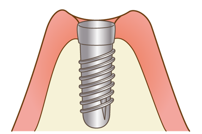 インプラント一次手術